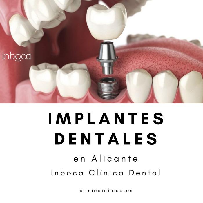 Mejores Implantes Dentales Alicante en Clínica Dental Inboca