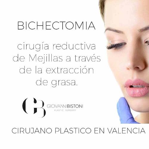 Bola de Bichat Valencia · Bichectomía con el Dr. Giovanni